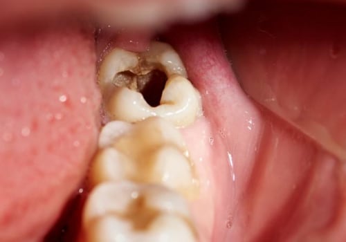 Severe Tooth Decay or Infection: Causes, Symptoms, and Treatment