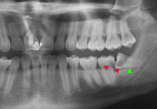 Everything You Need to Know About Surgical Extraction of Impacted Teeth