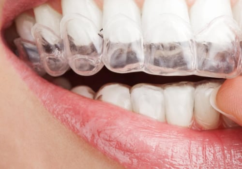 Whitening Strips, Gels, and Pens: A Comprehensive Overview