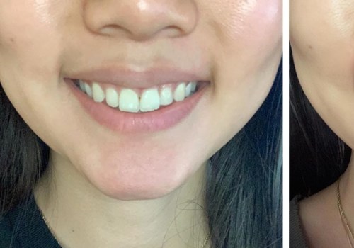 Teeth Whitening with Toothpaste and Mouthwash