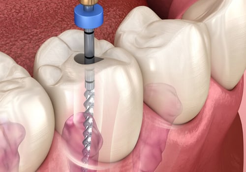 Diagnosis and Preparation for Root Canal Treatment