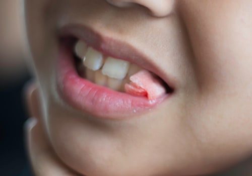 Caring for a Wound After an Extraction: A Guide