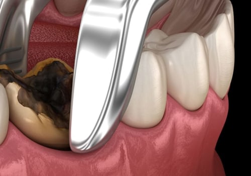 The Basics of Tooth Extractions