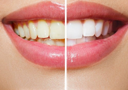 Laser Teeth Whitening Treatments: An In-Depth Look