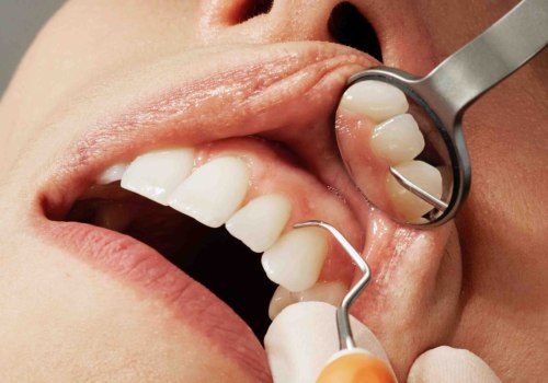 Veneers: An Overview of a Popular Cosmetic Dentistry Procedure