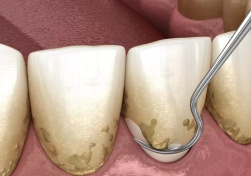 Advanced Gum Disease (Periodontal Disease)