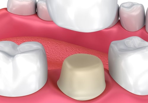 Restoring the Tooth with a Crown