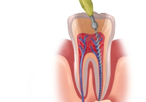 Eating after a Root Canal Treatment